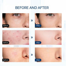 Load image into Gallery viewer, Clinical Deluxe HD Laser Light Facial Treatment Therapy Pod